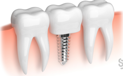 IMPLANTOLOGIA GRATUITA perché lo studio dentistico non procede con questa iniziativa?